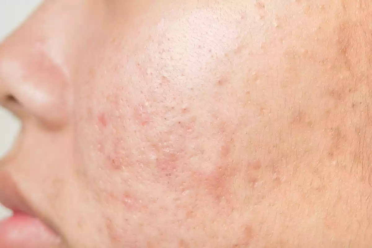 Primer plano de la mejilla de una persona con acné