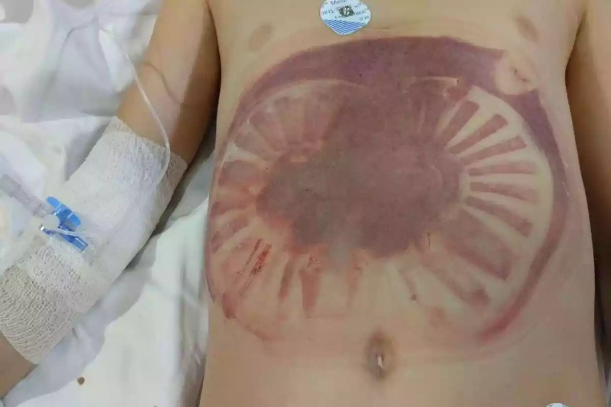 Hematoma de un niño succionado por una piscina